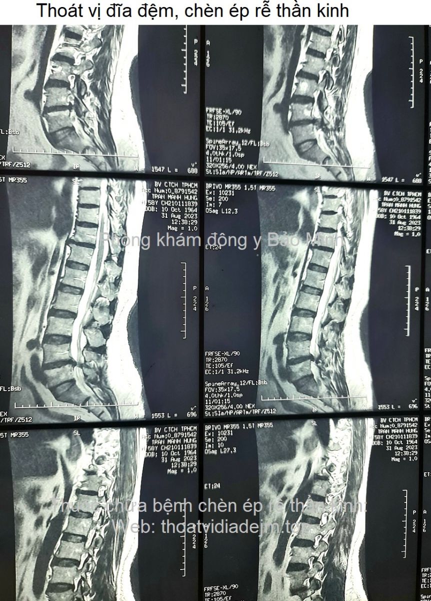 Thoát vị đĩa đệm, chèn ép rễ thần kinh